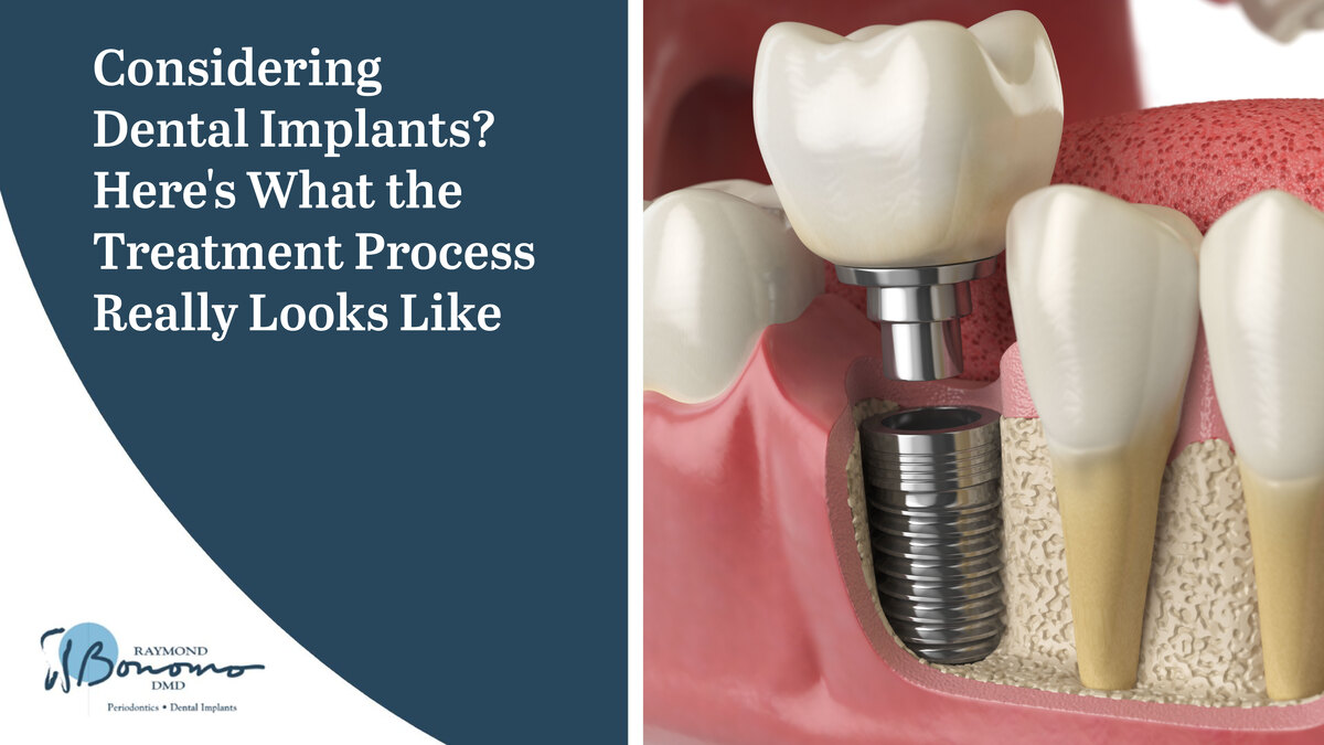 Considering Dental Implants? Here's What the Treatment Process Really Looks Like