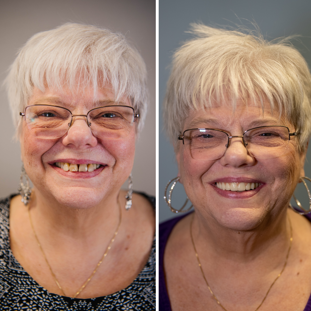 A before and after photo of a woman smiling