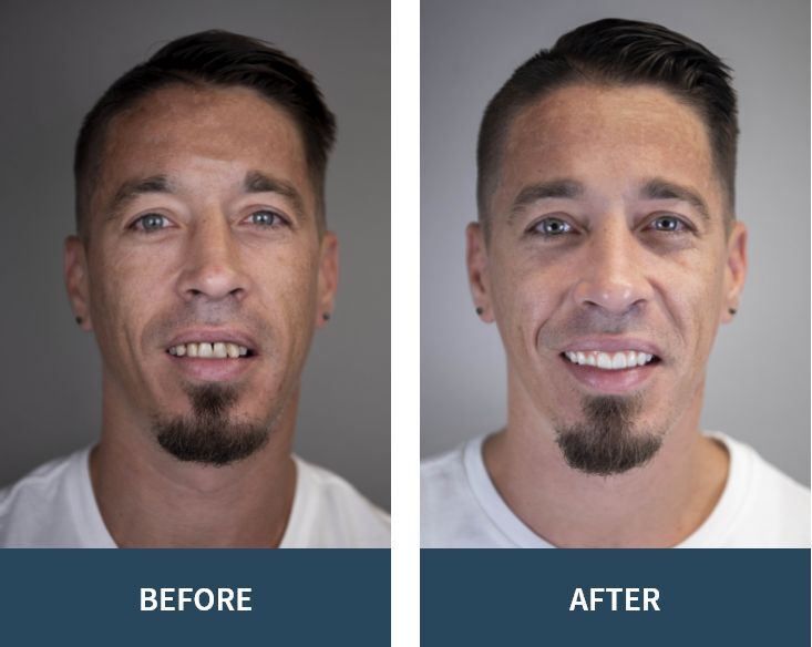 Before and after transition of smile