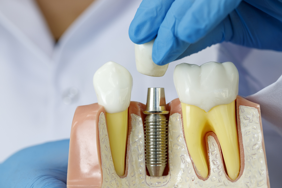 A dental implant model