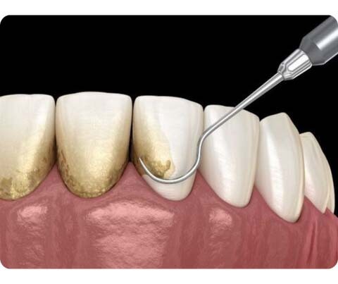 build-up being scraped off tooth