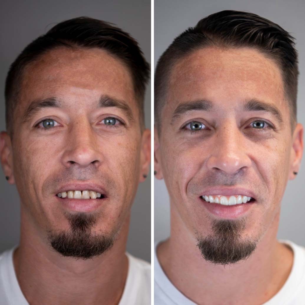 man's smile before and after