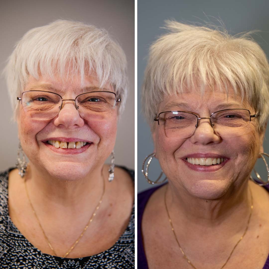 woman's smile before and after