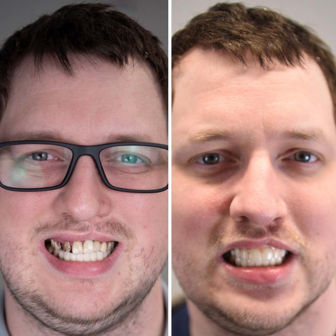 man's smile before and after